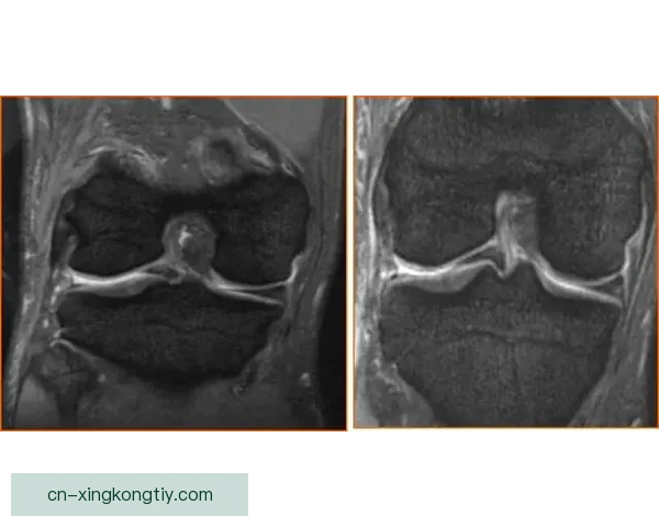 官方越南U23中卫膝韧带撕裂